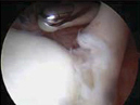 SLAP 병변의 관절경 사진