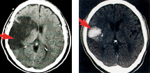 뇌졸중의 종류 이미지